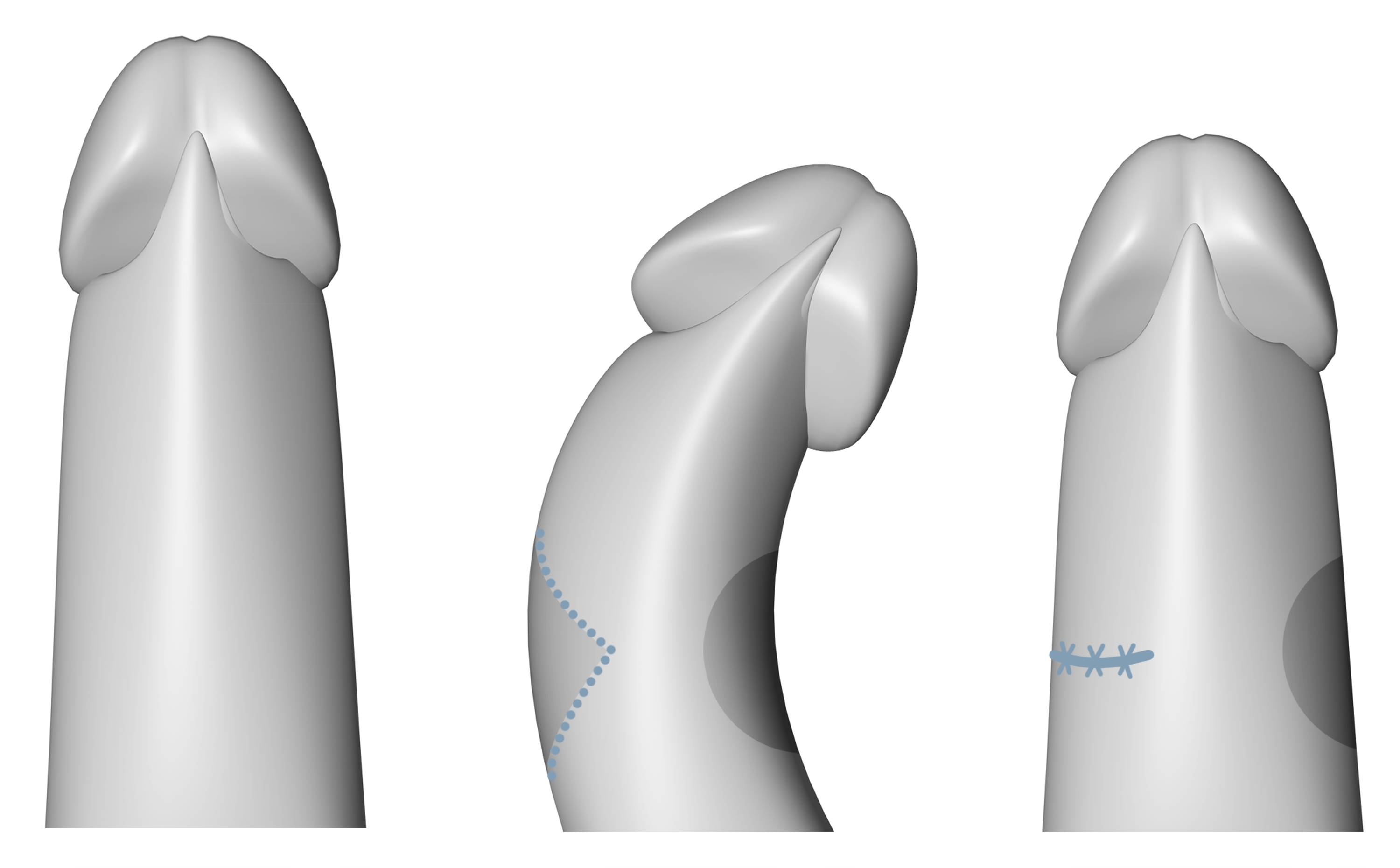 Cutting technique for operative penile straightening (Peyronie)